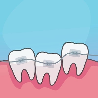 EPS 해외이미지 행복 일러스트 건강 치과 병원 사람 치료 뷰티 약 금속 장비 흰색 입 플랫 치아 입술 치과의사 철사 고정 턱 돌봄 위생관리 직진 치아교정 구강학 해외202309 해외일러스트 감정 컬러 의학 모션 재질 관리 신체부위 의사 소화기관 교정 파일형식 벡터
