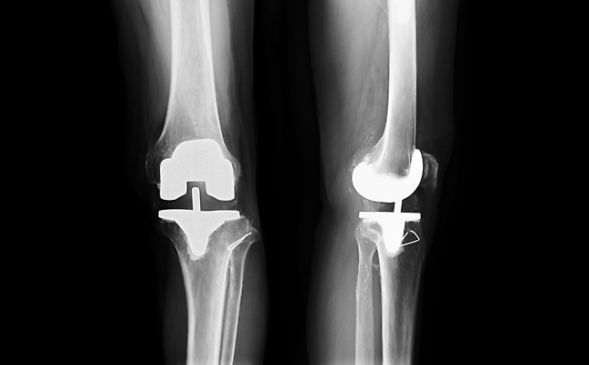 포토 JPG 해외이미지 해부 뼈 골격 엑스레이 건강 병원 사람 사람없음 약 금속 고통 시험 환자 의사 광선 질병 X 필름 관절염 무릎 골다공증 외과 허벅지 골절 교체 깨짐 돌봄 방사선 염증 정형외과 해외202309 해외포토 알파벳 교육 감정 컨셉 의학 모션 재질 신체부위 의료진 파일형식