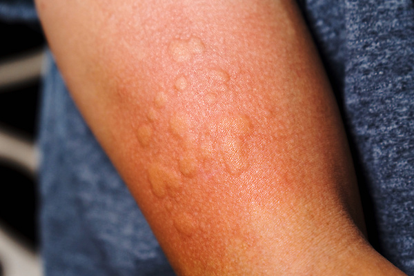 포토 JPG 해외이미지 백인 손 여자 신체 건강 사람 동양인 사람없음 치료 빨간색 약 고통 짜증 뜨거움 질병 피부 감염 문제 팔 테라피 알레르기 돌봄 반응 증상 해외202310 해외포토 서양인 감정 컬러 의학 모션 인종 신체부위 뷰티 파일형식