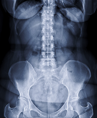 포토 JPG 해외이미지 모델 과학 백그라운드 곡선 신체 뼈 골격 엑스레이 병원 숙이기 사람 사람없음 약 검은색 고통 환자 의사 광선 기둥 디스크 비교 질병 필름 허리 척추 골다공증 돌봄 방사선 요통 정형외과 해외202310 해외포토 건축 감정 선 컬러 포즈 컨셉 의학 모션 신체부위 의료진 허리통증 파일형식