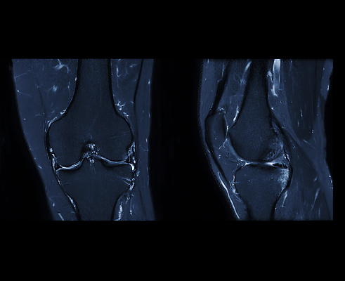 포토 JPG 해외이미지 스포츠 근육 뼈 골격 엑스레이 병원 사람없음 약 건강관리 진료 고통 시험 광선 필름 확인 무릎 자석 깨짐 방사선 스캐너 연골 정형외과 해외202310 해외포토 교육 감정 컨셉 의학 건강 관리 신체부위 파일형식