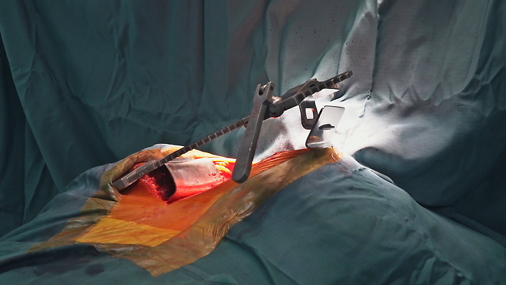 포토 JPG 해외이미지 과학 건강 병원 한명 약 장비 환자 의사 심장 수술 외과 교체 궤 보철 심장병 인공 절개 해외202310 해외포토 1 의학 사람 치료 의료진 장기_의학 질병 파일형식