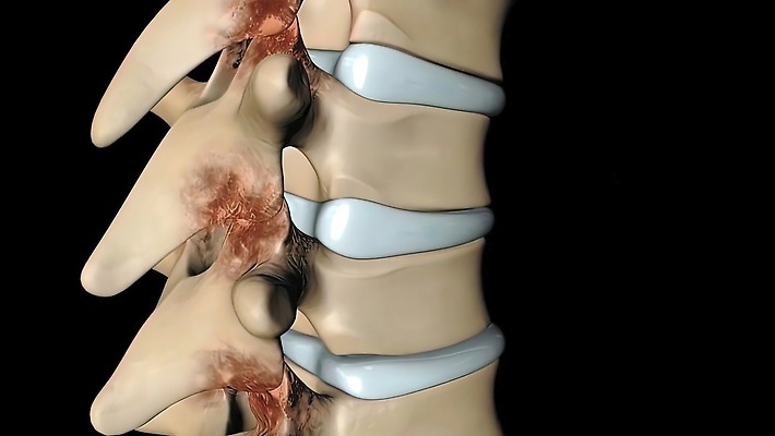 포토 JPG 해외이미지 척추동물 과학 백그라운드 신체 해부 뼈 골격 건강 사람 사람없음 약 고통 흰색 기둥 디스크 코드 질병 상처 척추 묘사 생물학 골다공증 외과 요통 해외202310 해외포토 동물 교육 건축 감정 컬러 의학 병원 허리통증 파일형식