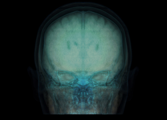 포토 JPG 해외이미지 엑스레이 건강 병원 사람없음 치료 약 머리 고통 환자 광선 질병 X 사인 뇌 함선 두통 고립 방사선 종양 타격 해골모형 해외202310 해외포토 알파벳 감정 배_교통 의학 모션 신체부위 모형 파일형식