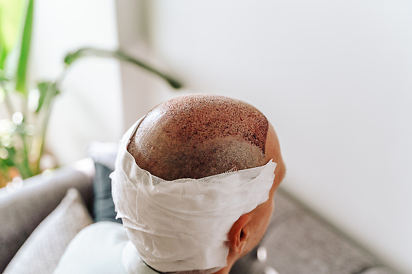 포토 JPG 해외이미지 백인 헤어스타일 남자 얼굴 백그라운드 의료기기 건강 한명 사람 성인 치료 뷰티 약 머리 성장 흰색 닫기 상처 붕대 대머리 문제 외과 테라피 돌봄 위생관리 적자 탈모 전후 카피스페이스 효과 해외202310 해외포토 서양인 1 컬러 의학 모션 병원 관리 신체부위 공백 비교 증상 파일형식