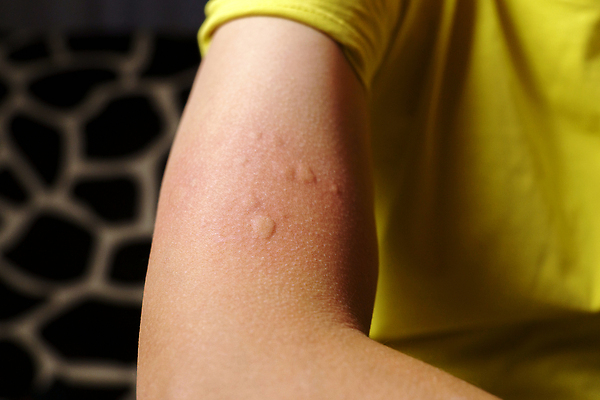 포토 JPG 해외이미지 손 남자 어린이 분홍색 백그라운드 건강 주사기 사람 사람없음 치료 빨간색 약 짜증 점 잡초 질병 피부 주사약 팔 알레르기 돌봄 면역력 반응 백신 심각 예방접종 예방주사 응답 해외202310 해외포토 식물 감정 컬러 컨셉 의학 의료기기 모션 신체부위 예방 접종 파일형식