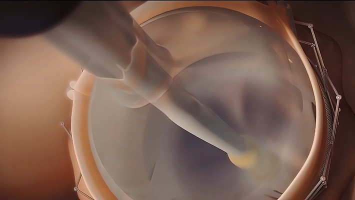 포토 JPG 해외이미지 사람없음 약 잠김 의사 심장 수술 맥박 회의실 함선 시스템 풍선 외과 해외202310 해외포토 배_교통 의학 병원 치료 의료진 장기_의학 파일형식