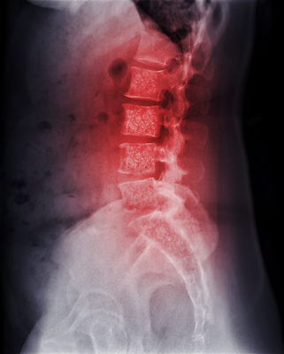 포토 JPG 해외이미지 과학 신체 해부 뼈 골격 엑스레이 건강 병원 사람 사람없음 약 고통 시험 환자 광선 기둥 디스크 질병 상처 X 필름 허리 척추 관절염 외과 돌봄 방사선 옛날 정형외과 해외202310 해외포토 알파벳 교육 건축 감정 의학 모션 신체부위 파일형식