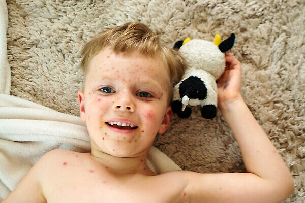 포토 JPG 해외이미지 남자 어린이 건강 소녀 두명 신체부위 빨간색 약 고통 환자 점 열 바이러스 질병 작음 피부 낫 걸음마 돌봄 증상 해외202310 해외포토 여자 감정 컬러 의학 모션 사람 크기 파일형식