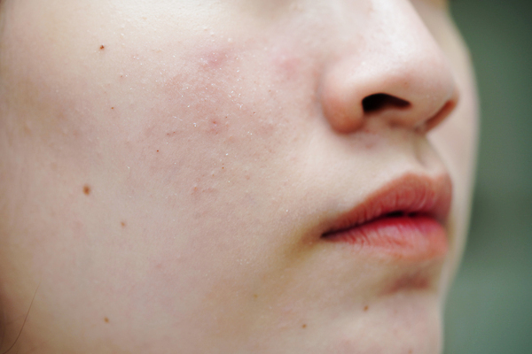 포토 JPG 해외이미지 여자 아시아 얼굴 건조 건강 한명 동양인 치료 빨간색 뷰티 약 화장품 점 기름 질병 상품 피부 피부관리 감염 문제 반대 여드름 돌봄 사춘기 위생관리 이마 흉터 못생김 해외202310 해외포토 1 나라 음식 컬러 의학 모션 관리 사람 인종 신체부위 상처 파일형식