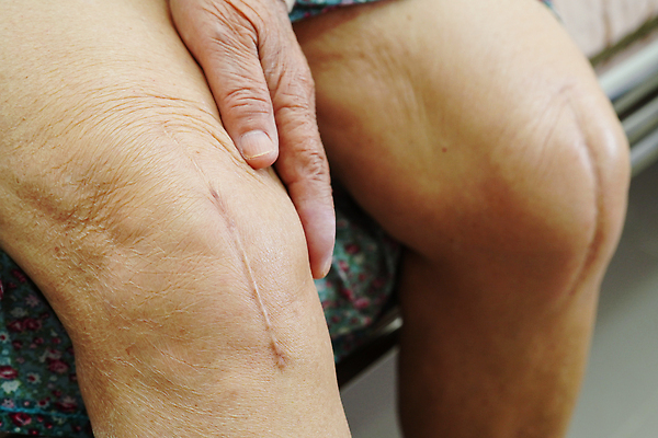 포토 JPG 해외이미지 여자 노년 신체 해부 건강 병원 한명 사람 성인 치료 약 금속 산책 고통 환자 긴급 수술 닫기 질병 상처 위험 자르기 간호 피부 관절염 땀 무릎 골다공증 섬유 외과 테라피 교체 돌봄 절개 치유 흉터 해외202310 해외포토 1 감정 컨셉 의학 모션 재질 휴식 신체부위 뷰티 직물 파일형식