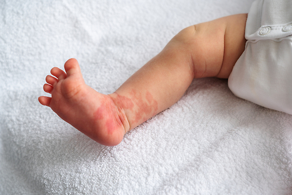 포토 JPG 해외이미지 어린이 신체 건강 사람없음 빨간색 약 성장 아기 신생아 점 얼룩 질병 피부 발목 두더지 양발 종양 해외202310 해외포토 컬러 의학 발 사람 신체부위 파일형식