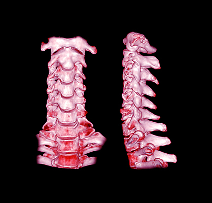 포토 JPG 해외이미지 접시 뼈 골격 건강 사람 사람없음 3D 고통 시험 환자 나사 질병 상처 X 척추 관절염 회전 목 C 고립 골절 방사선 염증 정형외과 해골모형 해외202310 해외포토 식기 알파벳 교육 감정 의학 병원 신체부위 모형 공구 디지털합성 파일형식