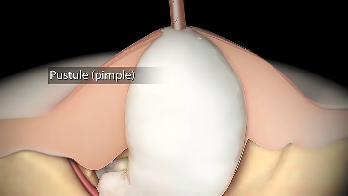 포토 JPG 해외이미지 모델 여자 얼굴 일러스트 청소년 돋보기 세포 건강 사람 사람없음 치료 10대 뷰티 약 인포그래픽 무대 짜증 신선 점 얼룩 불안 피부 입술 그림 감염 문제 테라피 박테리아 여드름 돌봄 사춘기 염증 이마 못생김 해외202310 해외포토 감정 의학 모션 신체부위 질병 파일형식