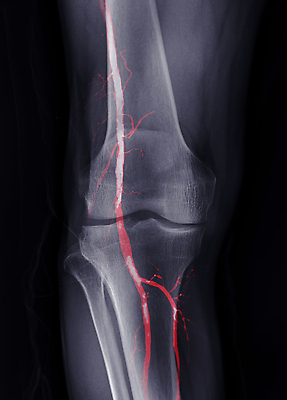 포토 JPG 해외이미지 해부 뼈 골격 엑스레이 건강 병원 서기 사람 사람없음 약 3D 금속 고통 시험 환자 광선 질병 X 필름 관절염 함선 무릎 골다공증 허벅지 동맥 교체 돌봄 염증 정형외과 해외202310 해외포토 알파벳 교육 감정 배_교통 의학 모션 재질 신체부위 디지털합성 혈관 파일형식