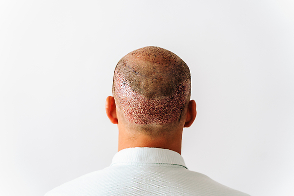 포토 JPG 해외이미지 백인 헤어스타일 남자 얼굴 백그라운드 의료기기 건강 한명 사람 성인 치료 뷰티 약 머리 성장 흰색 상처 대머리 문제 외과 테라피 돌봄 위생관리 적자 전후 카피스페이스 효과 해외202310 해외포토 서양인 1 컬러 의학 모션 병원 관리 신체부위 공백 비교 파일형식