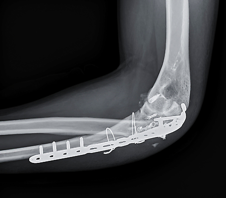 포토 JPG 해외이미지 손 백그라운드 신체 부분 해부 벽지 뼈 골격 병원 사람 사람없음 약 고통 장비 시험 환자 흰색 긴급 질병 사건 필름 라디오 팔 골절 단절 방사선 부담 염증 정형외과 팔꿈치 해외202310 해외포토 교육 감정 컬러 의학 신체부위 전자제품 파일형식