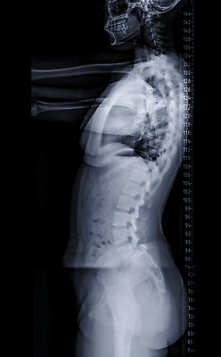 포토 JPG 해외이미지 과학 백그라운드 곡선 신체 해부 뼈 골격 엑스레이 건강 병원 숙이기 서기 사람 사람없음 약 검은색 고통 환자 의사 광선 흰색 기둥 비교 질병 필름 허리 척추 골다공증 돌봄 방사선 정형외과 해외202310 해외포토 건축 감정 선 컬러 포즈 컨셉 의학 모션 신체부위 의료진 파일형식