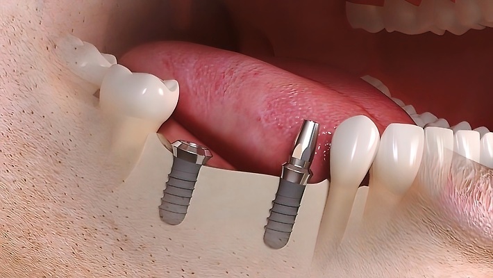 포토 JPG 해외이미지 전통 해부 왕관 치과 미소 사람없음 치료 약 건강관리 도자기 발표 치아 치과의사 뿌리 고정 주사약 닻 외과 틀니 백자 보철 복원 설치 인공 잇몸 지원 치아교정 치유 티타늄 구강학 해외202310 해외포토 신체 의학 표정 건강 병원 관리 의사 소화기관 원소 교정 파일형식