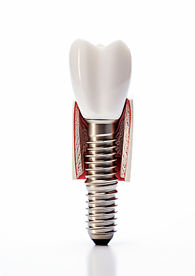 JPG 편집이미지 치과 사람없음 3D 수술 치아 치과용품 시술 치과진료 임플란트 편집3D AI컴퓨터그래픽 AI콘텐츠 의학 병원 치료 진료 의료용품 소화기관 디지털합성 파일형식