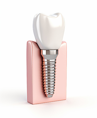 JPG 편집이미지 치과 사람없음 3D 수술 치아 치과용품 시술 치과진료 임플란트 잇몸 편집3D AI컴퓨터그래픽 AI콘텐츠 신체 의학 병원 치료 진료 의료용품 소화기관 디지털합성 파일형식