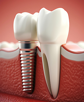 JPG 편집이미지 치과 사람없음 3D 수술 치아 치과용품 시술 치과진료 임플란트 잇몸 편집3D AI컴퓨터그래픽 AI콘텐츠 신체 의학 병원 치료 진료 의료용품 소화기관 디지털합성 파일형식