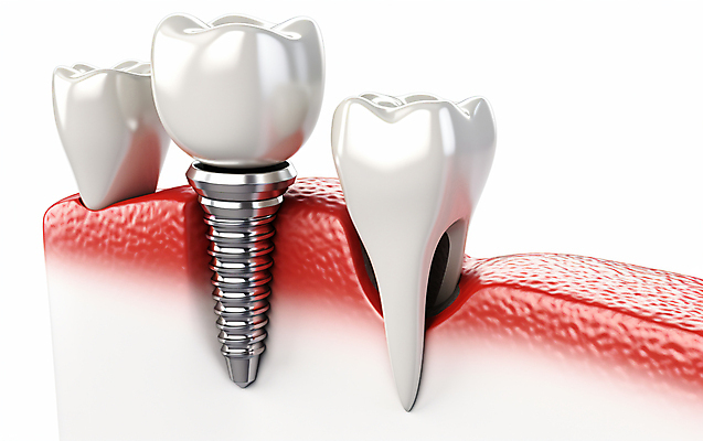 JPG 편집이미지 치과 사람없음 3D 수술 치아 치과용품 시술 치과진료 임플란트 잇몸 편집3D AI컴퓨터그래픽 AI콘텐츠 신체 의학 병원 치료 진료 의료용품 소화기관 디지털합성 파일형식