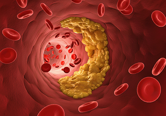 JPG 편집이미지 세포 사람없음 디지털합성 혈관 적혈구 막힘 콜레스테롤 내장지방 편집실사 AI컴퓨터그래픽 AI콘텐츠 장기_의학 지방_기름 CG 혈구 파일형식