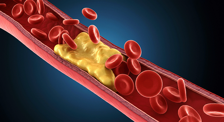 JPG 편집이미지 세포 사람없음 디지털합성 혈관 적혈구 막힘 콜레스테롤 내장지방 편집실사 AI컴퓨터그래픽 AI콘텐츠 장기_의학 지방_기름 CG 혈구 파일형식