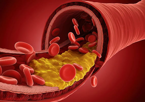 JPG 편집이미지 세포 사람없음 디지털합성 혈관 적혈구 막힘 콜레스테롤 내장지방 편집실사 AI컴퓨터그래픽 AI콘텐츠 장기_의학 지방_기름 CG 혈구 파일형식