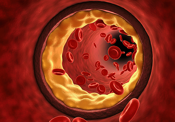 JPG 편집이미지 세포 사람없음 디지털합성 혈관 적혈구 막힘 콜레스테롤 내장지방 편집실사 AI컴퓨터그래픽 AI콘텐츠 장기_의학 지방_기름 CG 혈구 파일형식