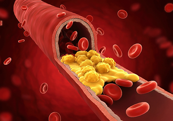 JPG 편집이미지 세포 사람없음 디지털합성 혈관 적혈구 막힘 콜레스테롤 내장지방 편집실사 AI컴퓨터그래픽 AI콘텐츠 장기_의학 지방_기름 CG 혈구 파일형식