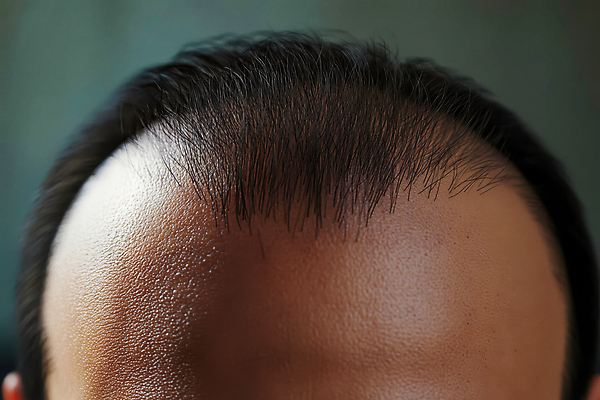 JPG 편집이미지 신체부위 머리카락 머리 피부 두피 탈모 의료성형뷰티 편집실사 AI인물포토 AI콘텐츠 사람 CG 증상 파일형식 AI포토