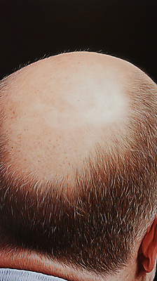 JPG 편집이미지 신체부위 머리카락 머리 피부 두피 원형탈모 의료성형뷰티 편집실사 AI인물포토 AI콘텐츠 사람 CG 탈모 파일형식 AI포토