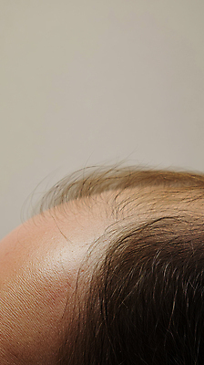 JPG 편집이미지 신체부위 머리카락 머리 피부 두피 탈모 의료성형뷰티 편집실사 AI인물포토 AI콘텐츠 사람 CG 증상 파일형식 AI포토