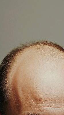 JPG 편집이미지 신체부위 머리카락 머리 피부 두피 원형탈모 의료성형뷰티 편집실사 AI인물포토 AI콘텐츠 사람 CG 탈모 파일형식 AI포토