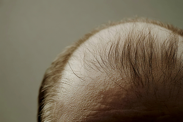 JPG 편집이미지 신체부위 머리카락 머리 피부 두피 탈모 의료성형뷰티 편집실사 AI인물포토 AI콘텐츠 사람 CG 증상 파일형식 AI포토