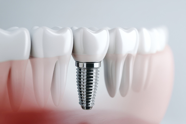 JPG 편집이미지 사람없음 수술 치아 임플란트 잇몸 편집실사 편집3D AI컴퓨터그래픽 AI콘텐츠 신체 의학 치과 치료 3D 소화기관 CG 파일형식