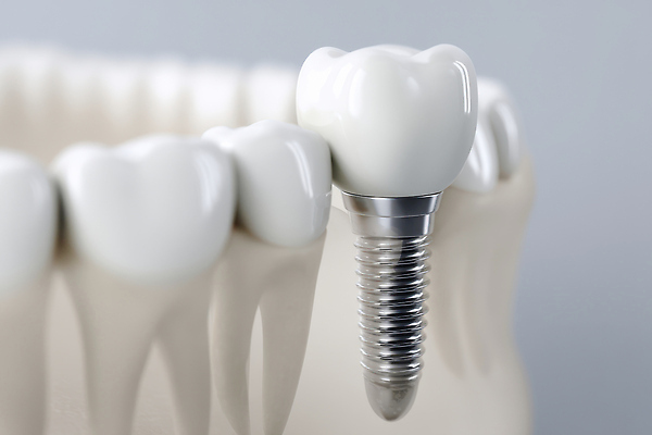 JPG 편집이미지 사람없음 수술 치아 임플란트 잇몸 편집실사 편집3D AI컴퓨터그래픽 AI콘텐츠 신체 의학 치과 치료 3D 소화기관 CG 파일형식