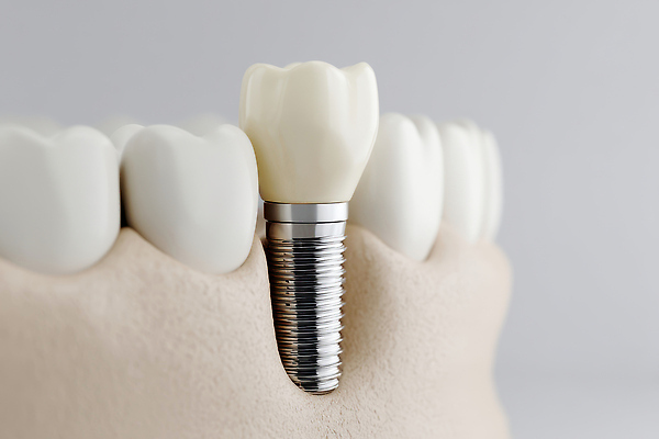 JPG 편집이미지 사람없음 수술 치아 임플란트 잇몸 편집실사 편집3D AI컴퓨터그래픽 AI콘텐츠 신체 의학 치과 치료 3D 소화기관 CG 파일형식