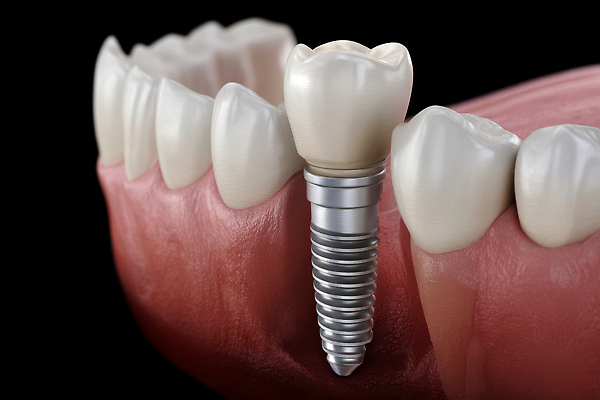 JPG 편집이미지 사람없음 수술 치아 임플란트 잇몸 편집실사 편집3D AI컴퓨터그래픽 AI콘텐츠 신체 의학 치과 치료 3D 소화기관 CG 파일형식
