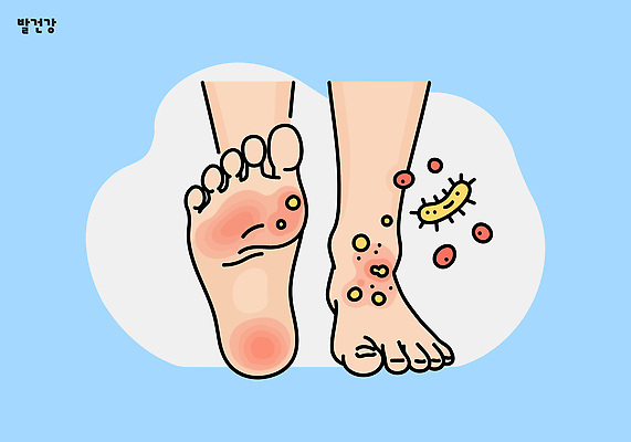 일러스트 건강 일상 치료 위생 세척 피부 예방 감염 혈액순환 발목 박테리아 두드러기 발관리 중요성 증상 국내일러스트 AI파일 컨셉 의학 발 3 라이프 신체부위 혈관 알레르기 파일형식 벡터