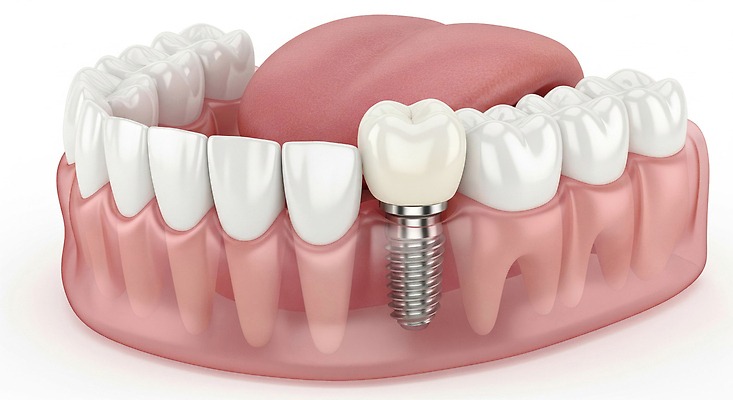 편집이미지 건축 신체 의학 모션 건강 치과 병원 도움 소화기관 파일형식 치아 임플란트 치료 모델 잇몸 기둥 시술 설명 구출 기본 디자인 JPG 치아건강 의료성형뷰티 이미지편집