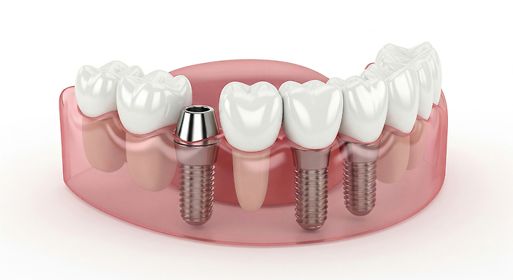 편집이미지 의학 표정 건강 치과 병원 도움 입 소화기관 파일형식 치아 임플란트 모델 치료 구출 구강 예방 상담 시술 미소 JPG 치아건강 의료성형뷰티 이미지편집
