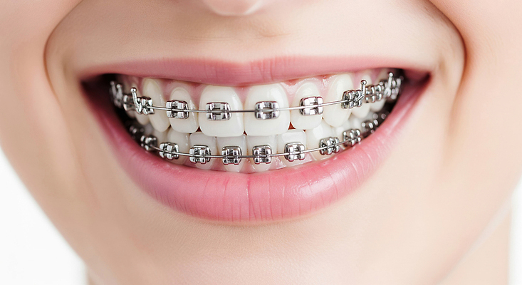 편집이미지 의학 표정 건강 병원 진료 소화기관 교정 파일형식 교정기 환자 미소 치아 치과 치아교정 치과진료 웃음 JPG 치아건강 의료성형뷰티 이미지편집