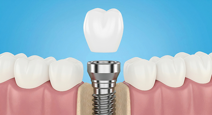 편집이미지 직업 의학 재질 건강 치과 병원 치료 의료진 소화기관 파일형식 임플란트 금속 치아 수술 환자 진료 의사 JPG 치아건강 의료성형뷰티 이미지편집