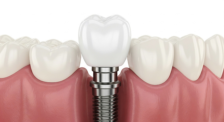 편집이미지 컨셉 신체 의학 표정 건강 치과 병원 입 소화기관 파일형식 임플란트 왕관 시술 환자 웃음 치아 치료 구강 잇몸 회복 기능 미소 예방 JPG 치아건강 의료성형뷰티 이미지편집
