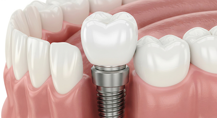 편집이미지 직업 신체 의학 재질 건강 치과 병원 소화기관 파일형식 임플란트 치아 치료 모형 시술 금속 잇몸 치아건강 진료 전문직 JPG 의료성형뷰티 이미지편집