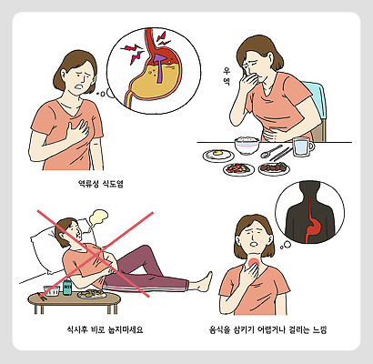 음식 일러스트 모션 건강 병원 약 식사 진료 상담 질병관리 예방 개선 생활습관 속쓰림 증상 불편함 역류성식도염 국내일러스트 AI파일 의학 감각 질병 습관 파일형식 벡터