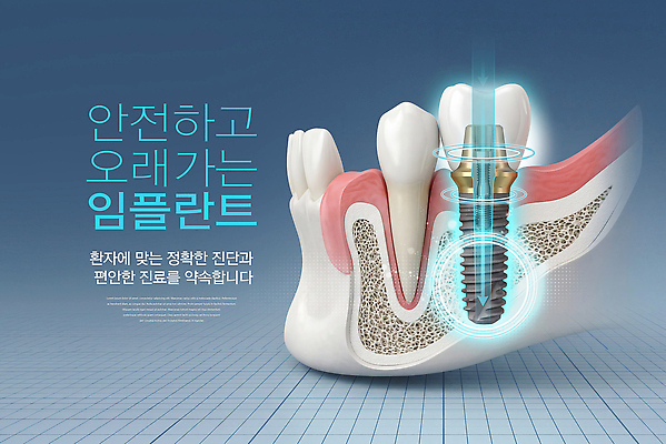 편집이미지 의학 모션 치과 병원 소화기관 파일형식 임플란트 시술 진료 치료 환자 뼈 치아 안전 정보 맞춤 기술 설명 이미지편집 PSD